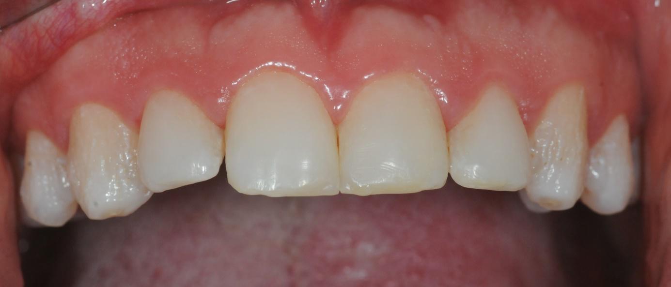 Amelogenesis imperfecta2.jpg